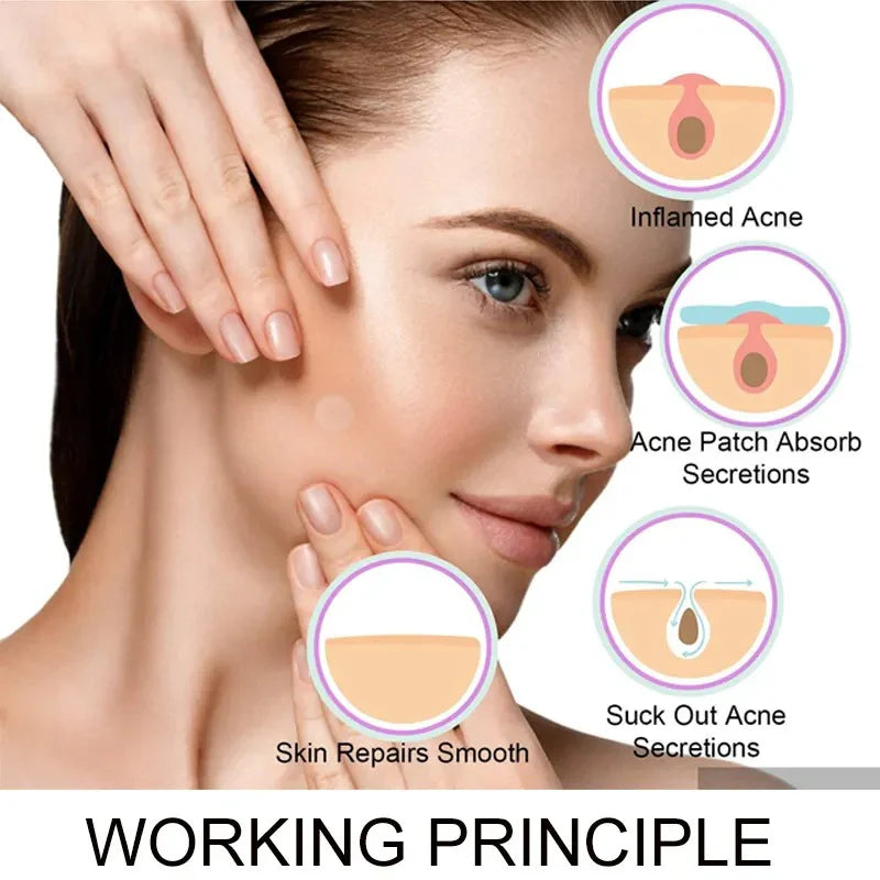 Face Acne Pimple Patch - Strip of 36 Pack Of 4 Strips | Pimple Healing & Spot Clearing Patch | Invisible, Hydrocolloid Skin Treatment for All Skin Types